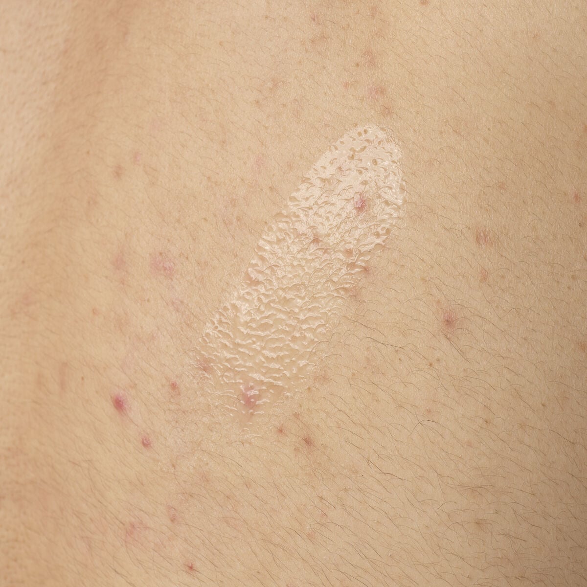 salicylic-acid-0-5-body-serum-a3 ORD-salicylic-acid-05-body-240ml-application.jpg