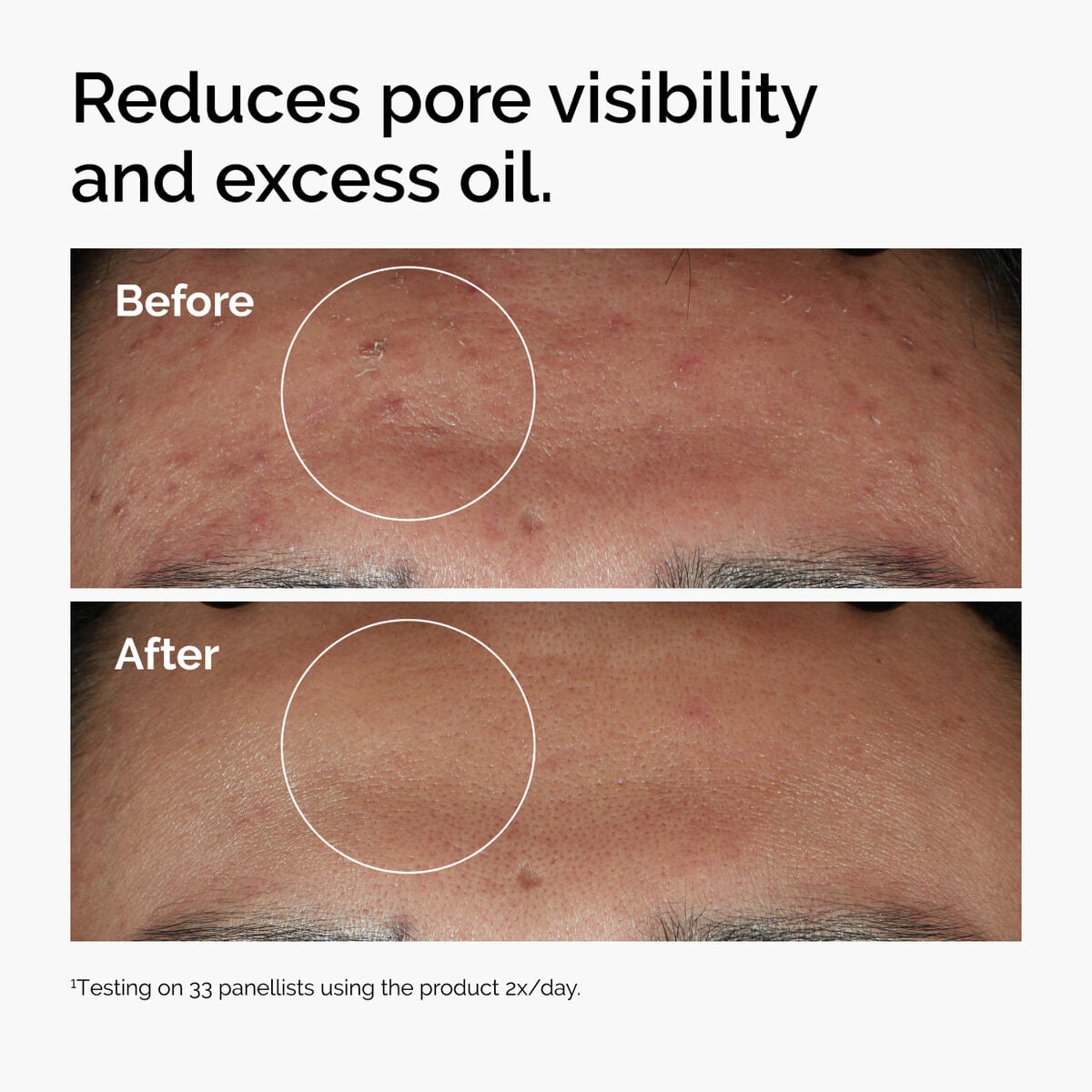niacinamide-10-zinc-1-f8 ord-niacinamide-zinc-blemish-serum-before-after-pores.jpg