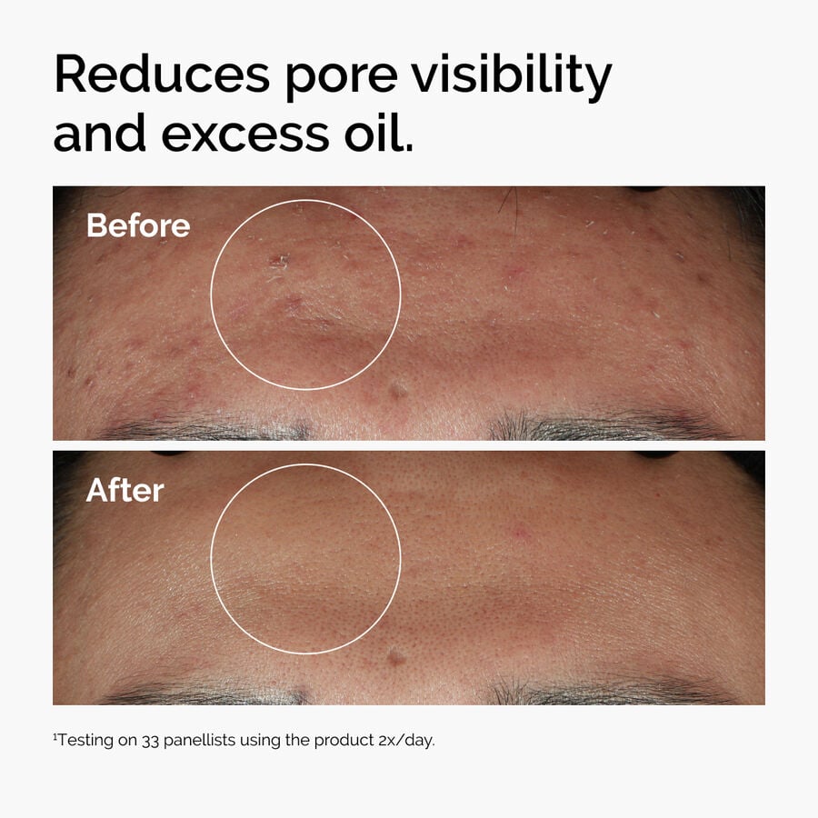 niacinamide-10-zinc-1-f8 ord-niacinamide-zinc-blemish-serum-before-after-pores.jpg