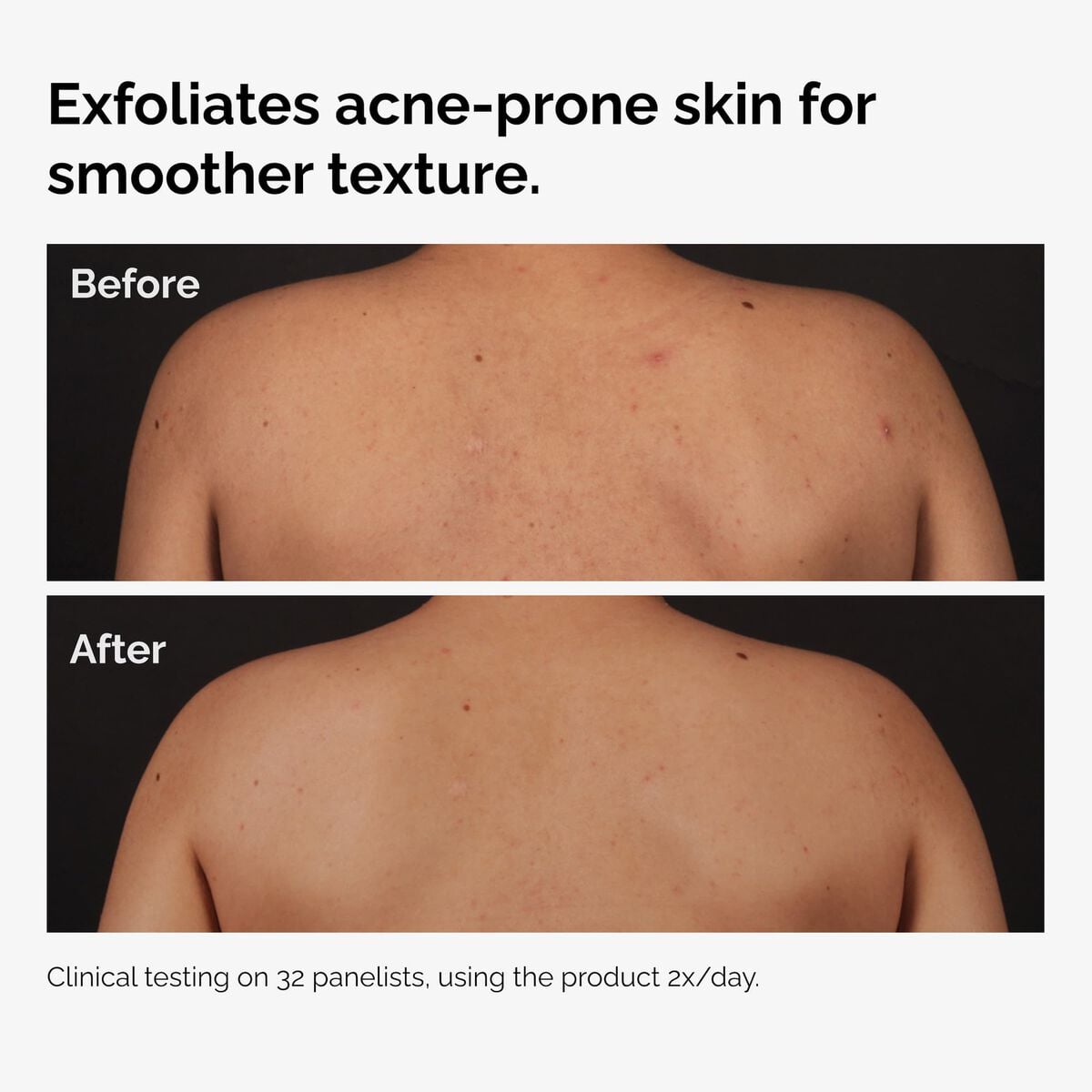 salicylic-acid-0-5-body-serum-a3 ord-salicylic-acid-body-serum-before-after-graphic-NA.jpg